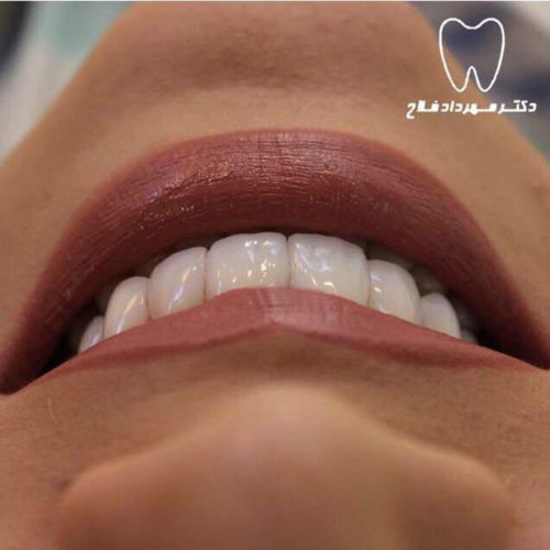 گالری عکس قبل و بعد روکش تمام سرامیک