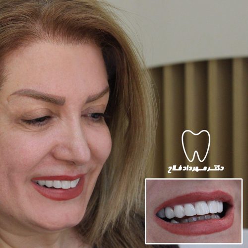 گالری عکس قبل و بعد روکش تمام سرامیک