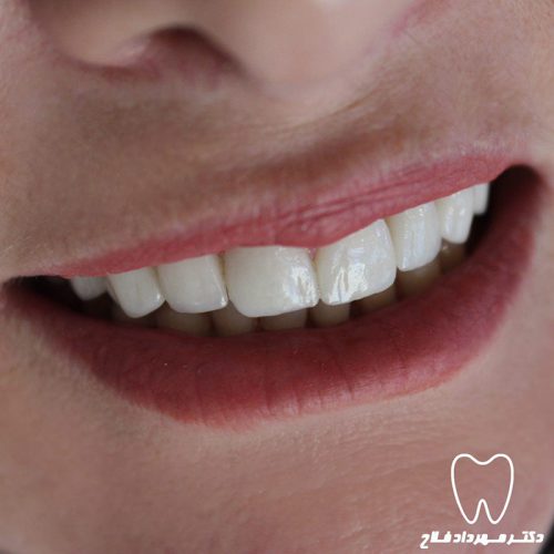 گالری عکس قبل و بعد روکش تمام سرامیک