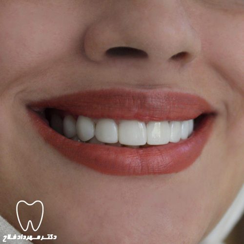 گالری عکس قبل و بعد روکش تمام سرامیک