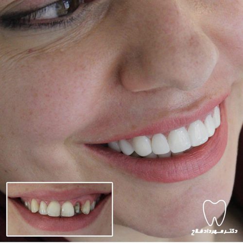 گالری عکس قبل و بعد روکش تمام سرامیک