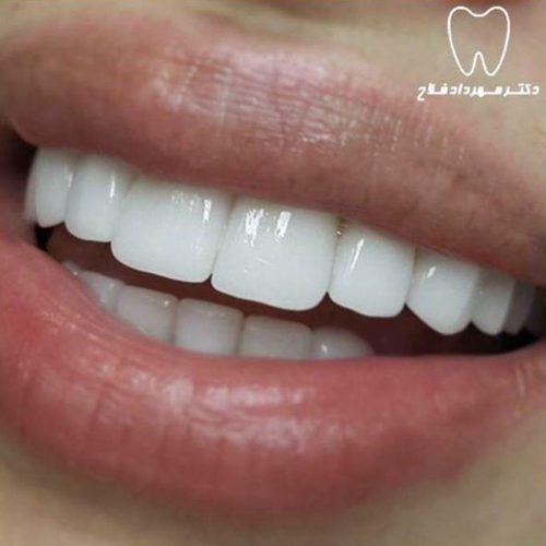 گالری عکس قبل و بعد روکش تمام سرامیک