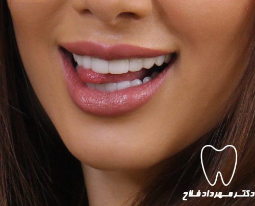 گالری عکس کامپوزیت دندان