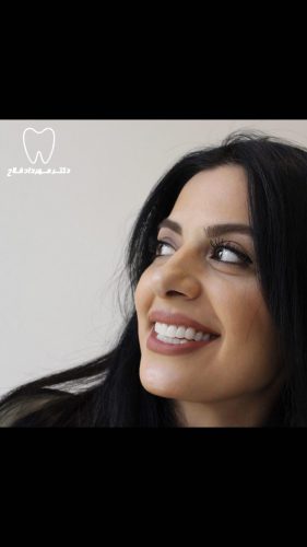 گالری عکس کامپوزیت دندان