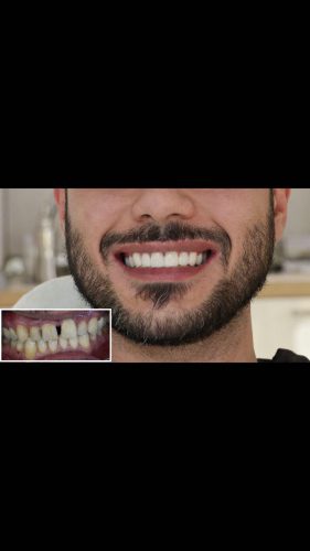 گالری عکس کامپوزیت دندان