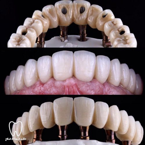 تعداد ايمپلنت لازم براى کاشت در شرایط مختلف بی دندانی