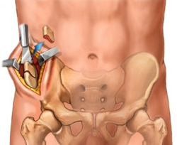 پیشگیری از تحلیل رفتن استخوان فک