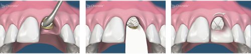 پیشگیری از تحلیل رفتن استخوان فک