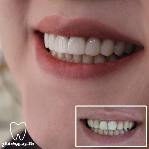 گالری عکس اصلاح تغییر رنگ دندان