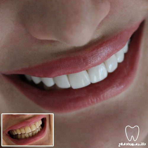 گالری عکس اصلاح تغییر رنگ دندان