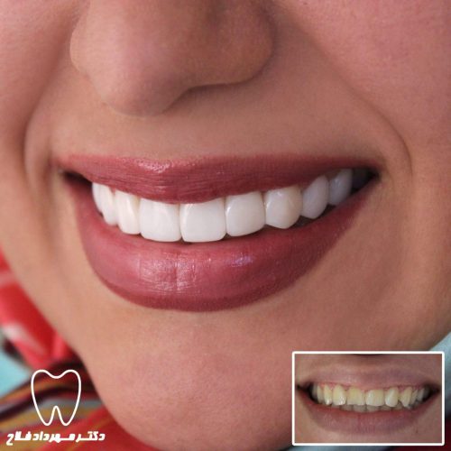 گالری عکس اصلاح تغییر رنگ دندان