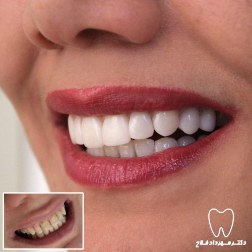 گالری عکس اصلاح تغییر رنگ دندان