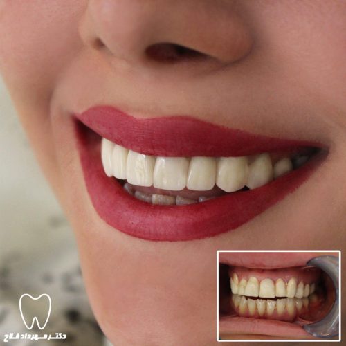 گالری عکس اصلاح تغییر رنگ دندان