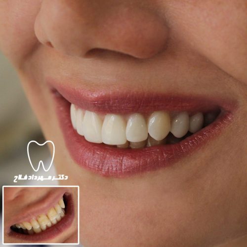 گالری عکس اصلاح تغییر رنگ دندان