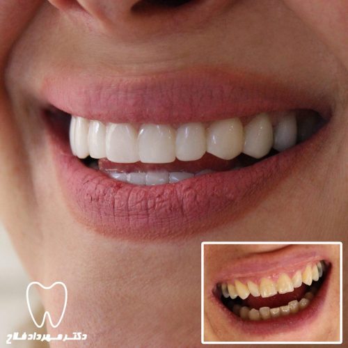 گالری عکس اصلاح تغییر رنگ دندان