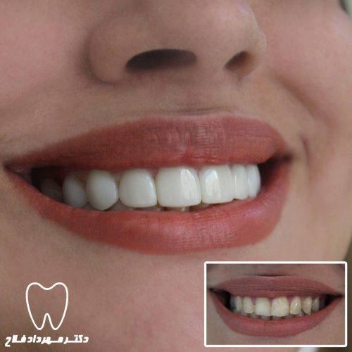 گالری عکس اصلاح تغییر رنگ دندان