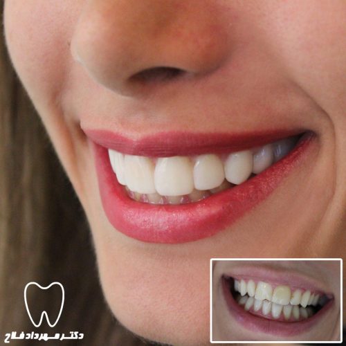 گالری عکس اصلاح تغییر رنگ دندان