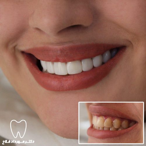 گالری عکس اصلاح تغییر رنگ دندان