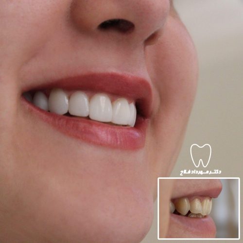 گالری عکس اصلاح تغییر رنگ دندان