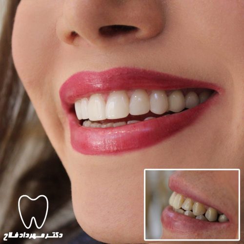 گالری عکس اصلاح تغییر رنگ دندان