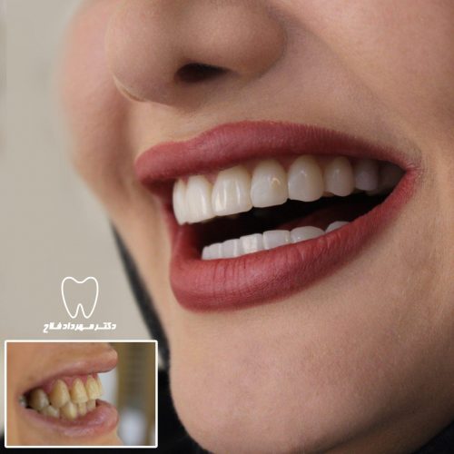 گالری عکس اصلاح تغییر رنگ دندان