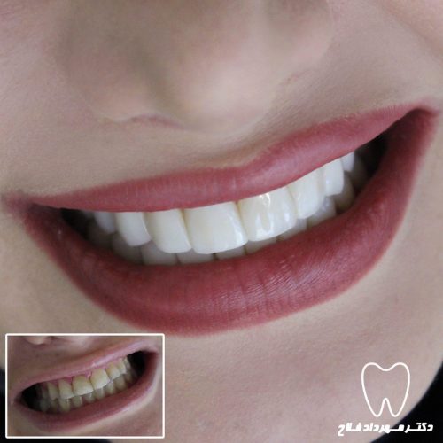 گالری عکس اصلاح تغییر رنگ دندان