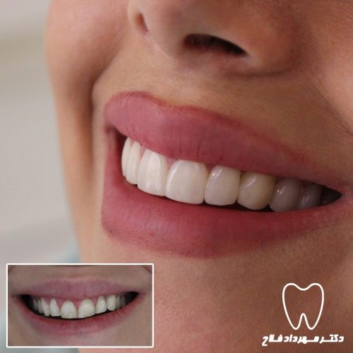 گالری عکس اصلاح تغییر رنگ دندان