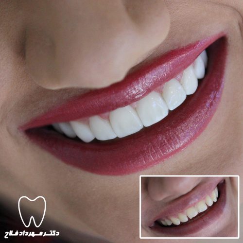 گالری عکس اصلاح تغییر رنگ دندان