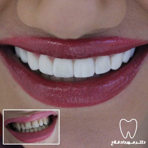 گالری عکس اصلاح تغییر رنگ دندان