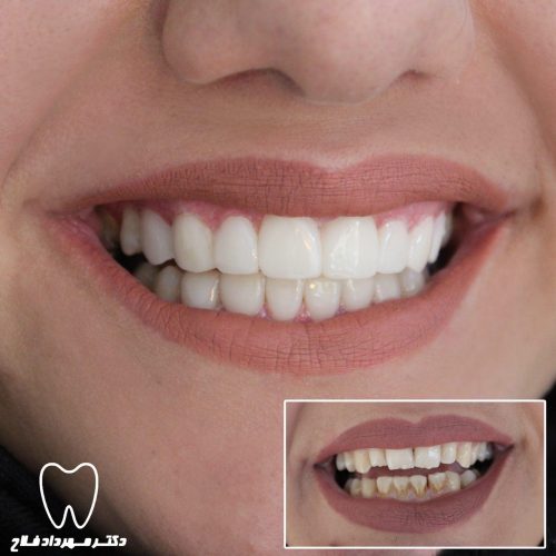 گالری عکس اصلاح تغییر رنگ دندان