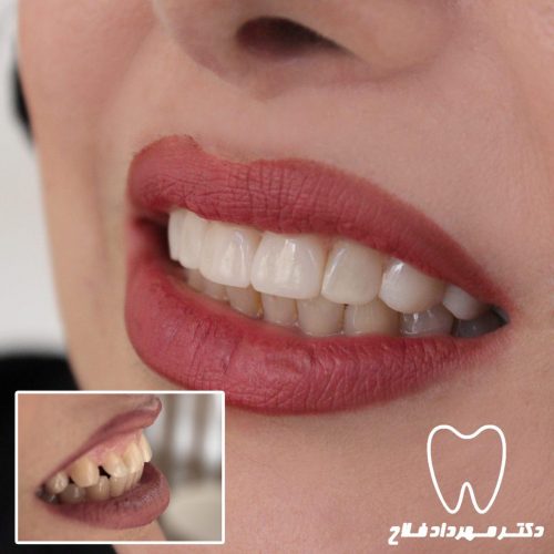 گالری عکس اصلاح فاصله بین دندان