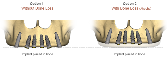 دندان مصنوعی کامل ثابت با پایه ایمپلنت