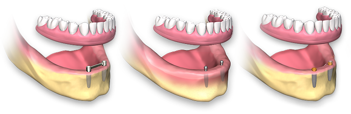 روشهای مختلف کاشت ست کامل دندان مصنوعی با پایه ایمپلنت 