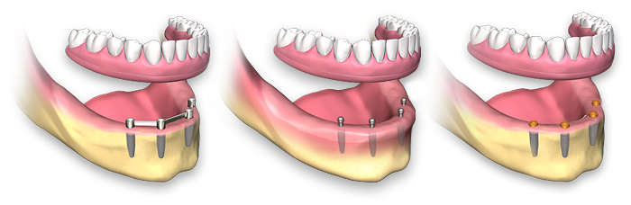 دندان مصنوعی کامل غیر ثابت بر روی چهار ایمپلنت