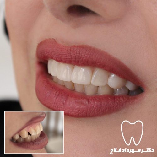 گالری عکس اصلاح شکل و فرم دندان