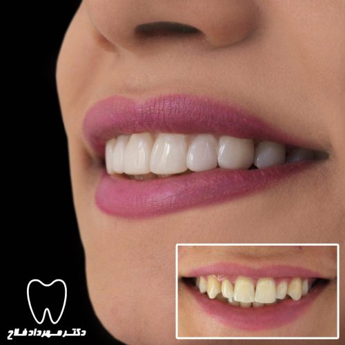 گالری عکس اصلاح شکل و فرم دندان