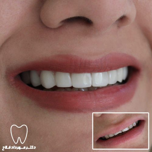 گالری عکس اصلاح شکل و فرم دندان