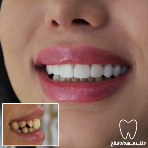 گالری عکس اصلاح شکل و فرم دندان