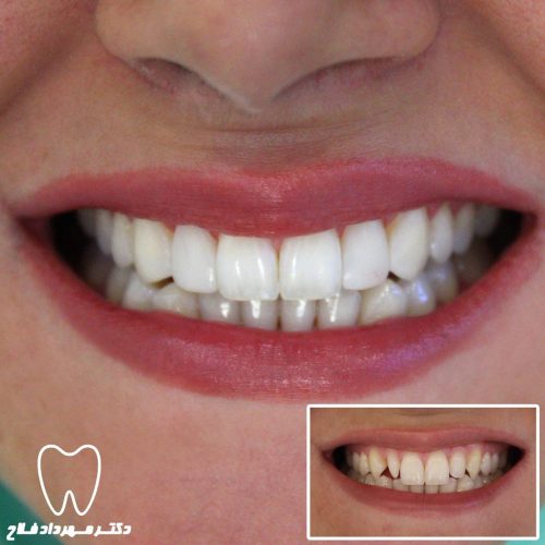 دندانپزشکی زیبایی و دندانهایی سفیدتر و زیباتر