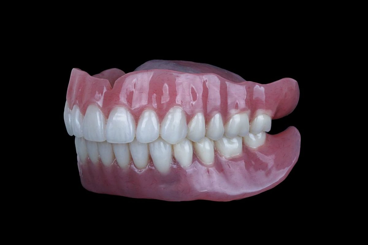 کاشت ست کامل دندان مصنوعی با پایه ایمپلنت2