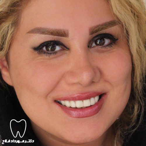 گالری عکس لامینیت