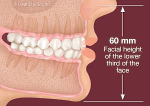 عوارض از دست دادن دندان چیست؟