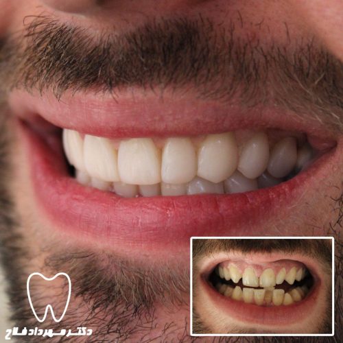 گالری عکس اصلاح نامرتبی دندان