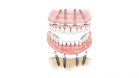 دندان مصنوعی و ایمپلنت جایگزین دندان از دست رفته