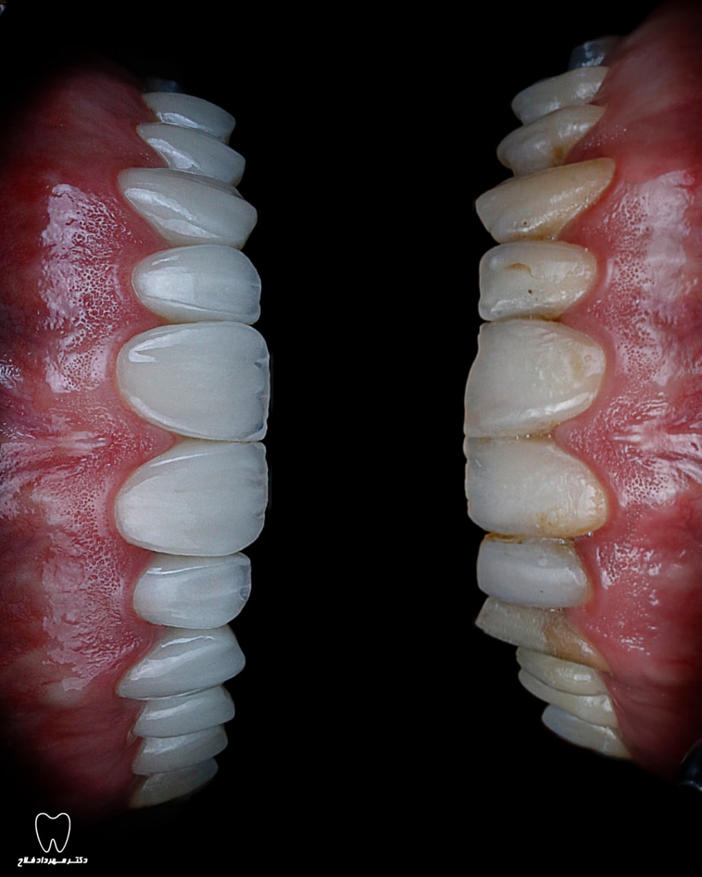 مرتب کردن دندانها بدون ارتودنسی با کمک لمینت دندان یا کامپوزیت دندان
