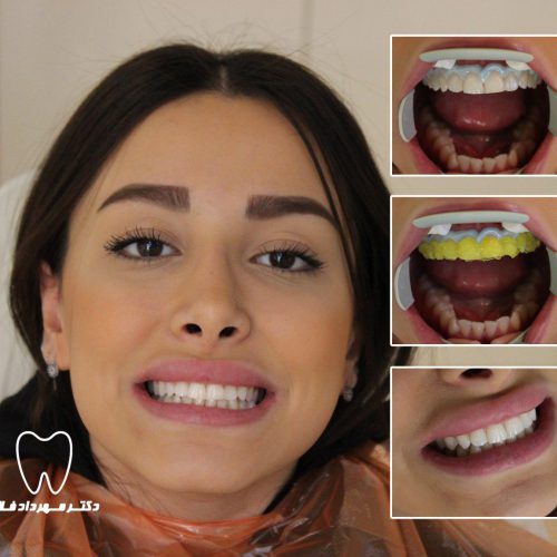 قیمت سفید کردن دندان ها قیمت سفید کردن دندان ها