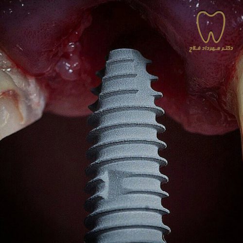 مراحل درمان ایمپلنت