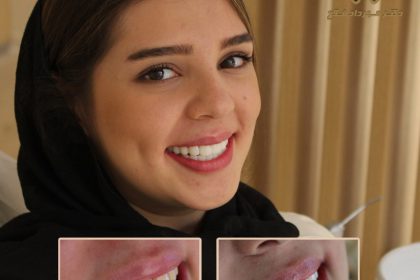 نمونه لمینت کردن دندان نمونه لمینت کردن دندان
