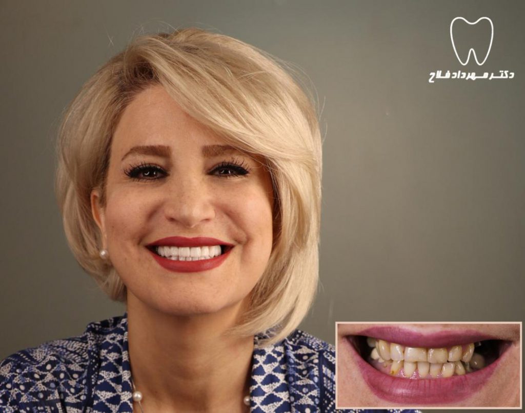 ویژگی ها و مزایای لمینت سرامیکی دندان
