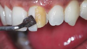 کدام نوع رزین کامپوزیت برای ترمیم یا زیبایی دندان بهتر است؟